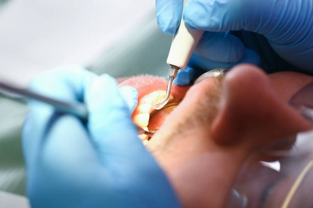 Best Emergency Dental Care for Sports Injuries in Pacolet, SC